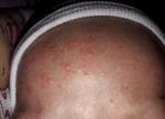 Что это аллергия или потница? фото 1