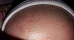 Что это аллергия или потница? фото 2