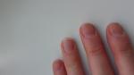 Повреждение ногтевой пластины на руках фото 2