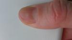 Повреждение ногтевой пластины на руках фото 3