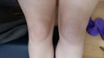 Артрит коленного сустава фото 1
