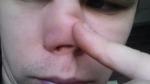Нарост на носу в виде сосочка фото 2