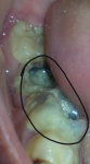 Болит большой коренной зуб с правой стороны фото 1