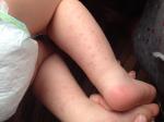 Сыпь на голенях и на руках у ребенка фото 4
