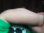 Сыпь на голенях и на руках у ребенка фото 5