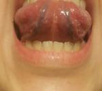 Воспаление языка и боли в горле фото 2