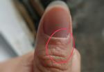 Изменение кожи возле ногтя фото 1