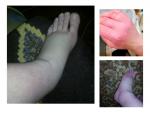 Возможен ли отек левой ноги при синдром Рейно? фото 2