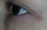 Шелушение на внешнем уголке глаза фото 1