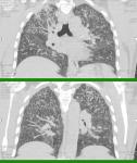 Фиброз лёгких и загрудиная боль фото 1