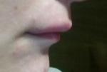 Опухла верхняя губа что делать? фото 3