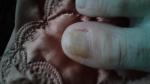 Грибок ногтей на ногтях ног с сильными болями фото 1