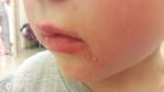 Покраснение вокруг губ у ребенка фото 2
