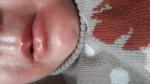 Покраснение вокруг губ у ребенка фото 3