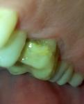 Потемнение зуба на границе пломбы фото 1