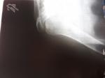 Перелом большого бугорки плечевой кости фото 1