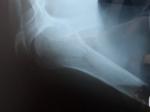 Перелом большого бугорки плечевой кости фото 2