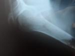 Перелом большого бугорки плечевой кости фото 3