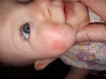 Раздражение на щеке ребенка фото 1