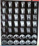 Результаты МРТ и рентгена после операции фото 2