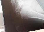 Перелом большого бугорки плечевой кости фото 4