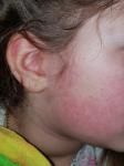 Аллергия у ребенка при нормальном имуноглобуллине фото 1