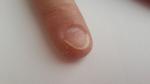 Ямки и неровности на ногтях рук фото 1