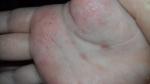 Аллергия на ладошках фото 3