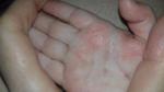 Аллергия на ладошках фото 1
