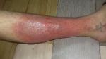 Кожные воспаления на ногах фото 2