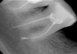 Инородное тело за каналом зуба фото 2