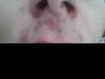 Шелушащиеся покраснения на брови и усах фото 3