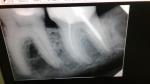 Пролеченный зуб фото 2