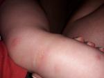 У ребенка красное воспаленое пятно заполненрое прыщиками фото 3