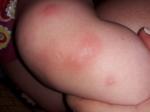 У ребенка красное воспаленое пятно заполненрое прыщиками фото 2