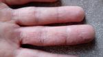 Экзема среднего пальца на правой руке с трещинами болезнеными фото 4