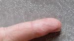 Экзема среднего пальца на правой руке с трещинами болезнеными фото 5