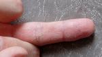Экзема среднего пальца на правой руке с трещинами болезнеными фото 3