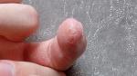 Экзема среднего пальца на правой руке с трещинами болезнеными фото 2