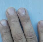 Шелушение и покраснение на пальцах рук фото 1