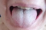 Белый налет на языке после тонзиллэктомиии фото 1