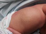 Необычное пятно на левом боку у новорожденного фото 3