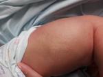Необычное пятно на левом боку у новорожденного фото 2