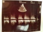 Двустворчатый аортальный клапан с регургитацией фото 2