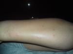 Сыпь на руках до локтя в виде комариных укусов фото 1