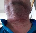 Воспаление(раздражение) кожи на горле фото 1