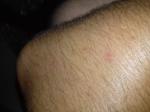 Мелкая сыпь на теле на волосеных луковицах фото 3