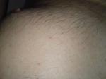 Мелкая сыпь на теле на волосеных луковицах фото 1