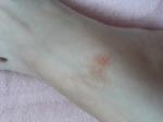 Кровоподтеки на ногах после укусов насекомых фото 3