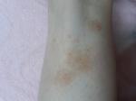 Кровоподтеки на ногах после укусов насекомых фото 4